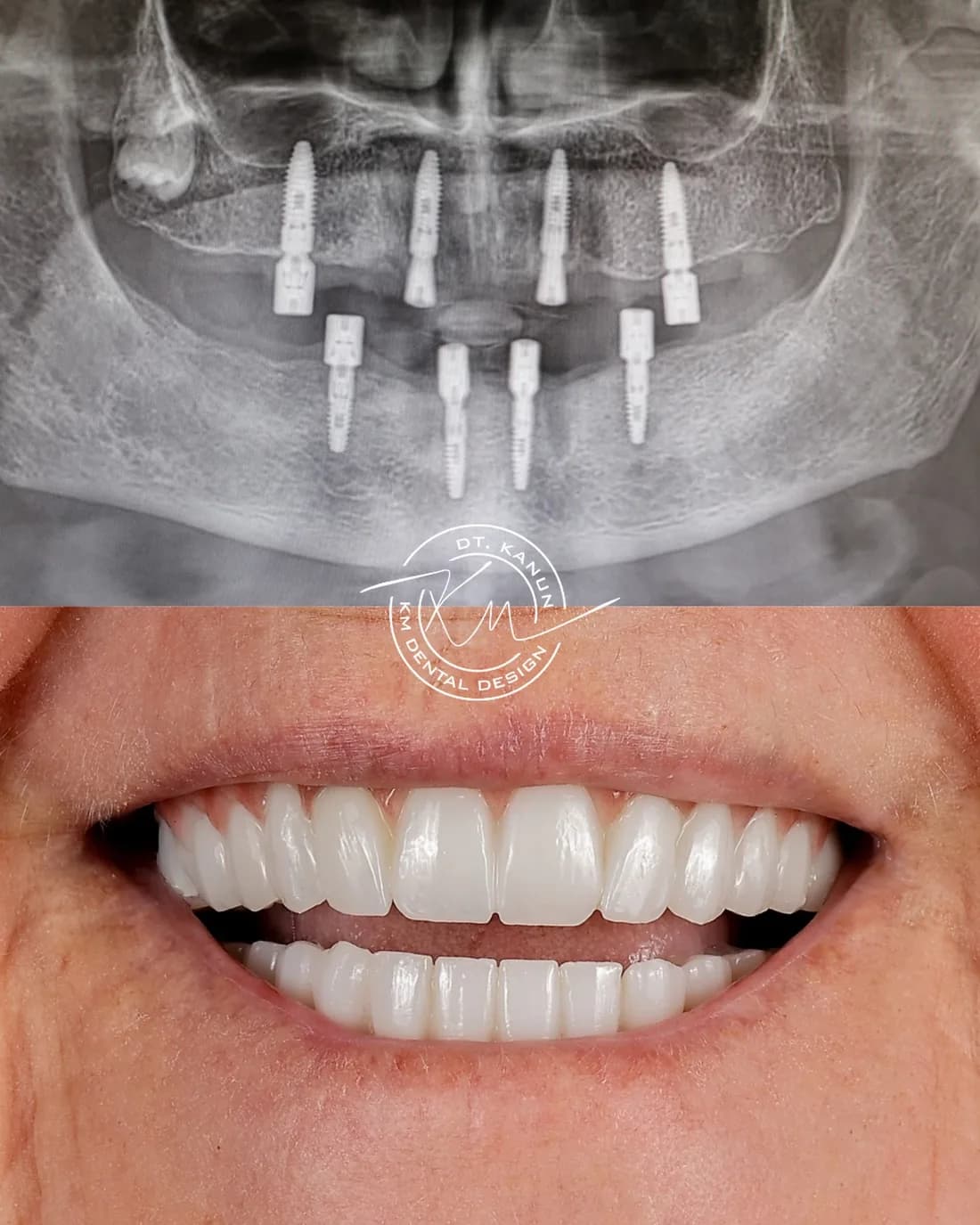 All-on-4 treatment at Dent KM clinic in Kusadasi, Turkey