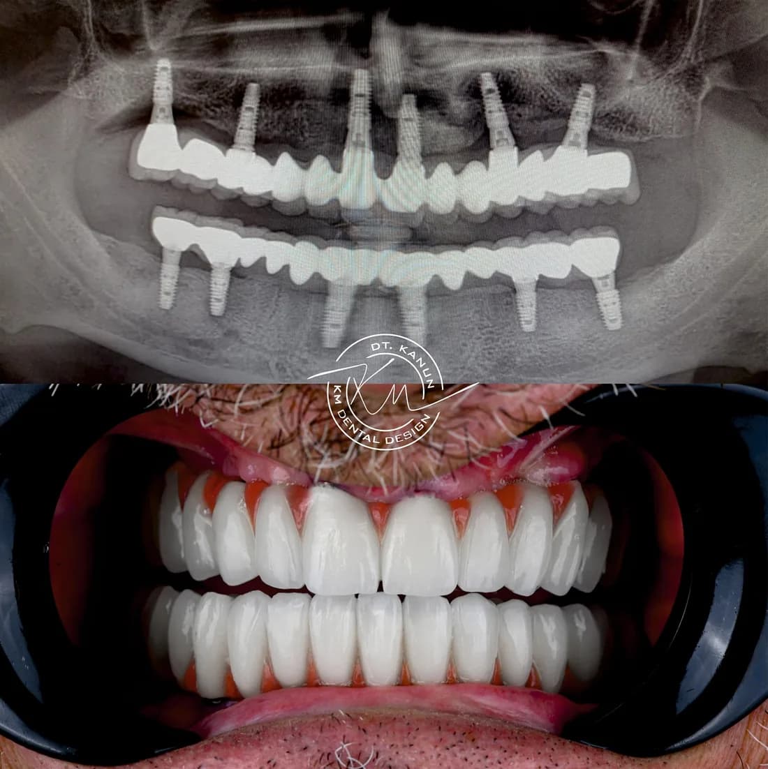 All-on-6 treatment at Dent KM clinic in Kusadasi, Turkey